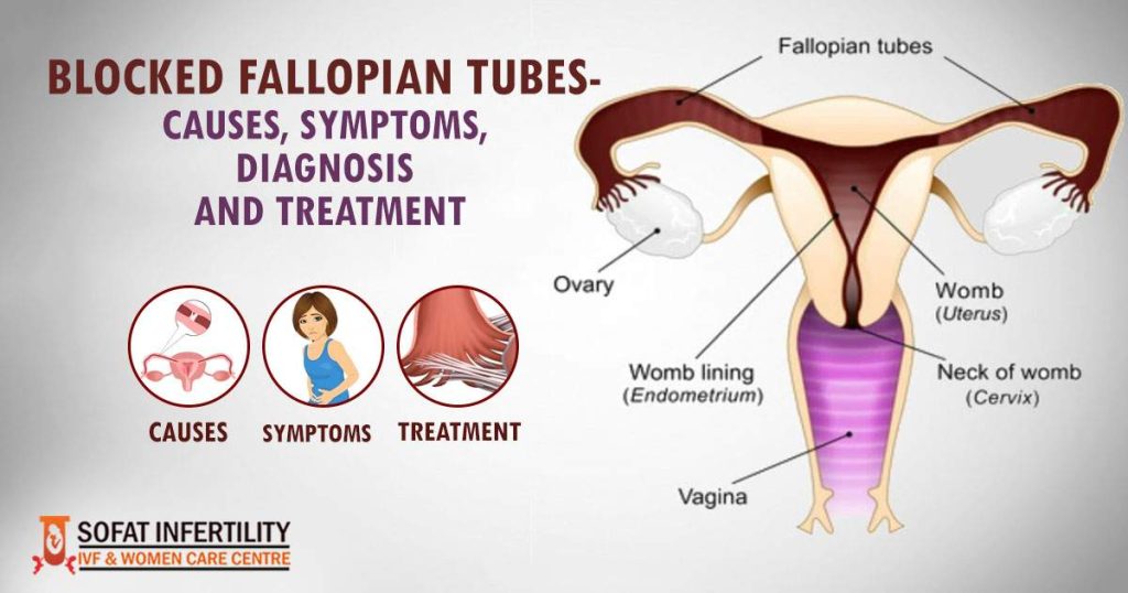 Blocked Fallopian Tubes- Causes, Symptoms, Diagnosis And Treatment