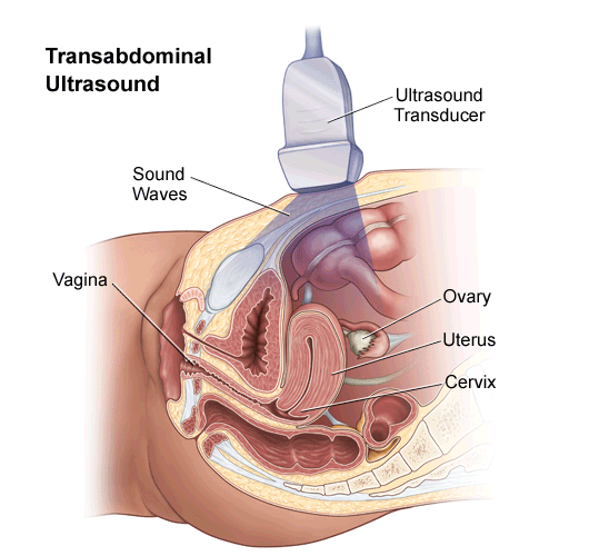 A Transvaginal Ultrasound and why it is performed