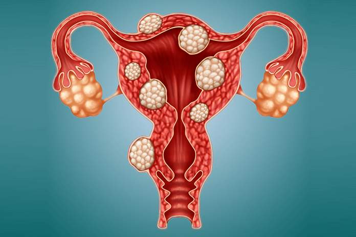 Eliminate Ovarian Cysts before they ruin you: Here are the Symptoms