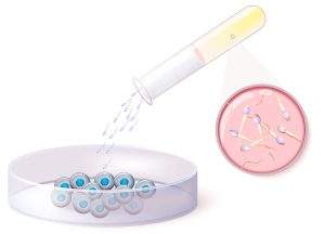 आईवीएफ टेक्नीक से उपचार का तरीका - IVF Treatment