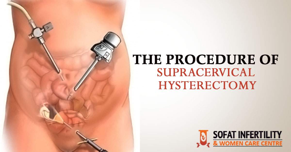The procedure of Supracervical hysterectomy
