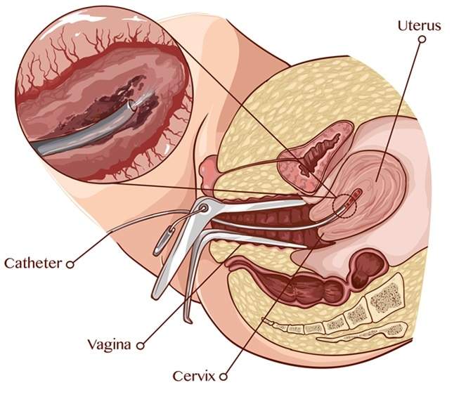 Endometrial Scratching & IVF | sofatinfertility.com