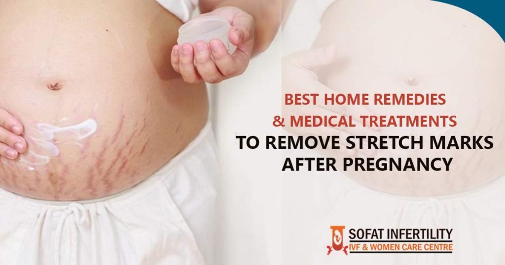 How to Remove Stretch Marks After Pregnancy | Home Remedies and Medical Treatments