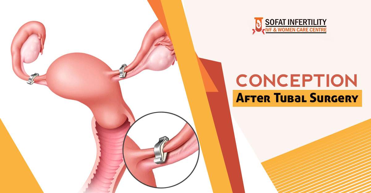 Conception after Tubal surgery Punjab - Sofat Infertility & Women Care Centre