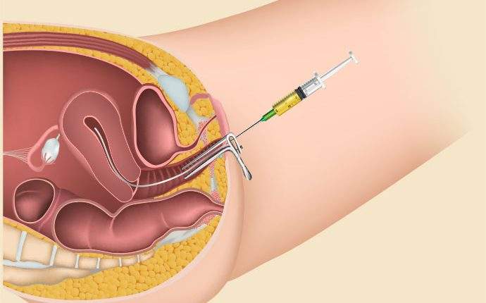 5 Factors Affecting the Cost of IUI Procedure