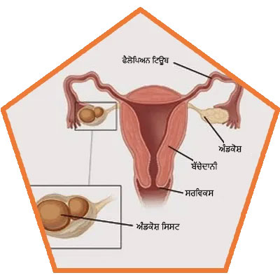 causes of Ovarian Cysts