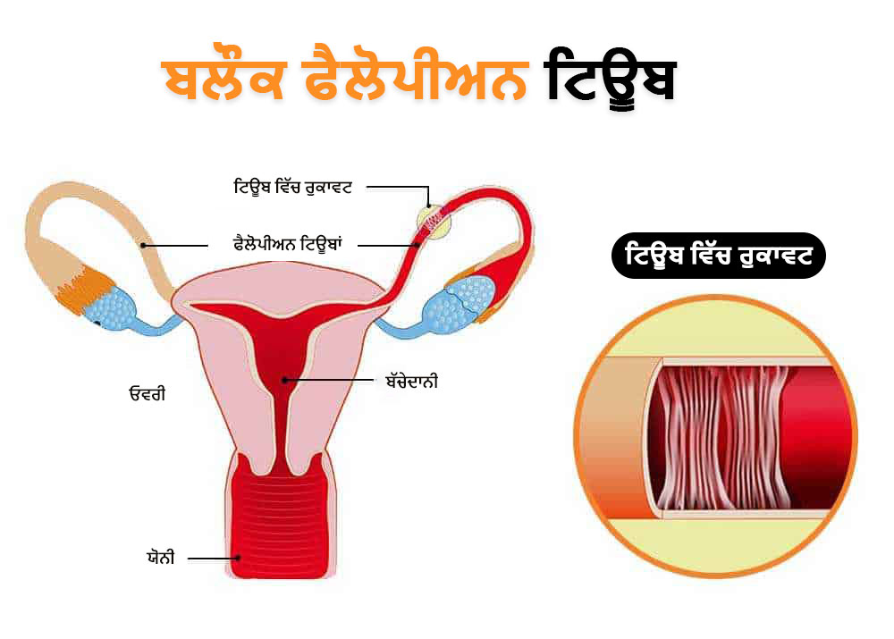 blocked fallopian tube