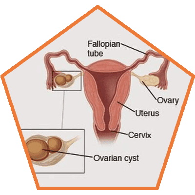 2.-Causes-of-Ovarian-Cysts