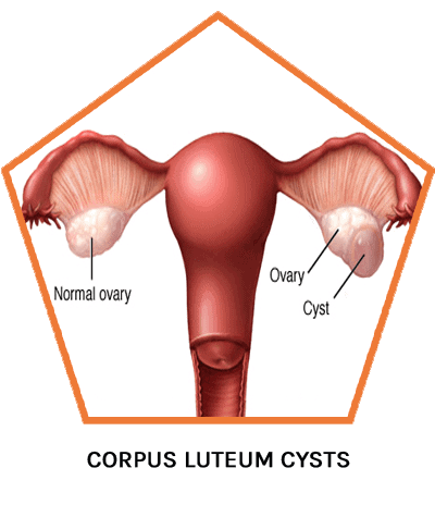 3.1-Ovarian-Cysts-Types-Corpus-luteum-cysts-1