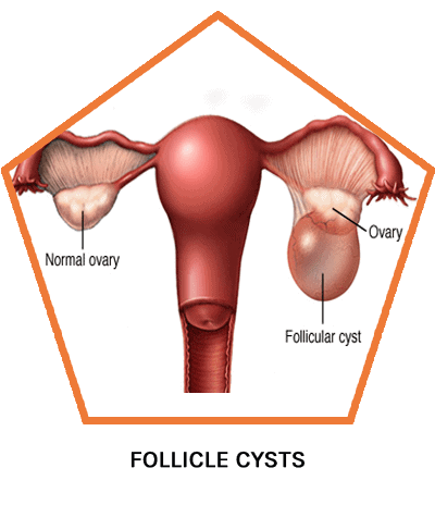 3.2-Ovarian-Cysts-Types-Follicle-cysts-1